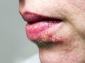 Fieses Lippenherpes mit Fieberbläschen