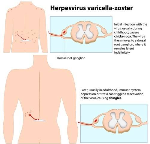 Herpes varicella-zoster Gürtelrose Entstehung