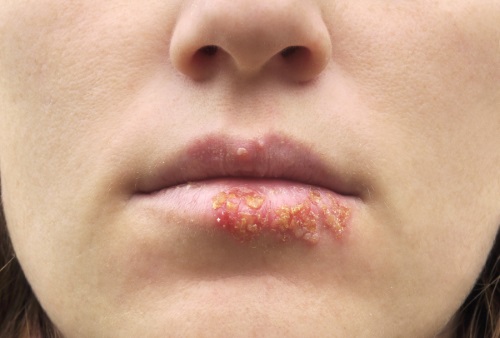 Lippenherpes: Eine Frau hat Herpesbläschen an der Lippe