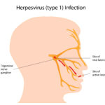 Herpes simplex Typ 1 im Nervenknoten in der Nähe der Schläfe